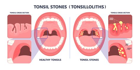 Tonsilloliths are stones located on or within t… oakdaleent.com