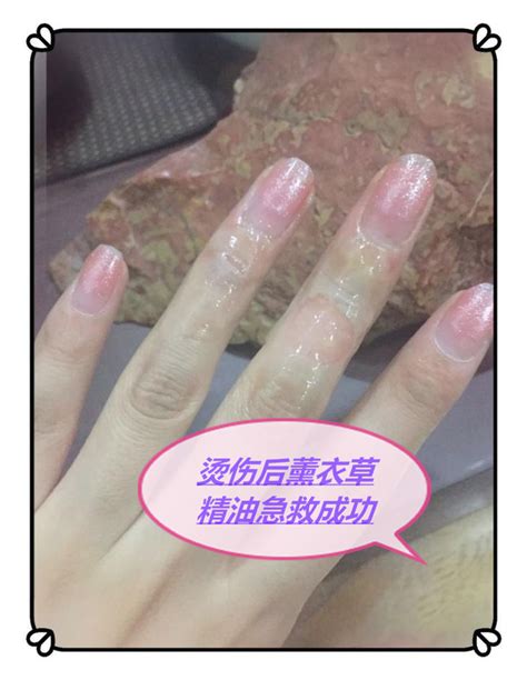 亲身经历分享~薰衣草精油治 …