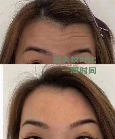 皱纹、刚刚产生时还属于动态性皱纹…