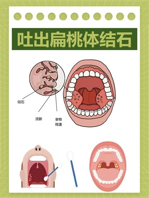 吐出扁桃体结石，是福还是祸…